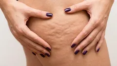 Mange kvinder er ikke klar over denne metode til at slippe af med cellulite.